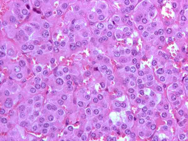 Diferencia entre el feocromocitoma y el neuroblastoma