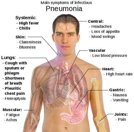 Différence entre la pneumonie et la bronchite