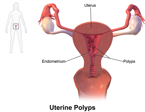 Różnica między polipami i fibroidami