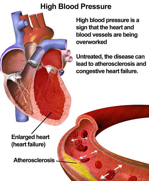 Perbezaan antara hipertensi primer dan sekunder