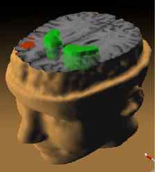 Différence entre la schizophrénie et la psychose