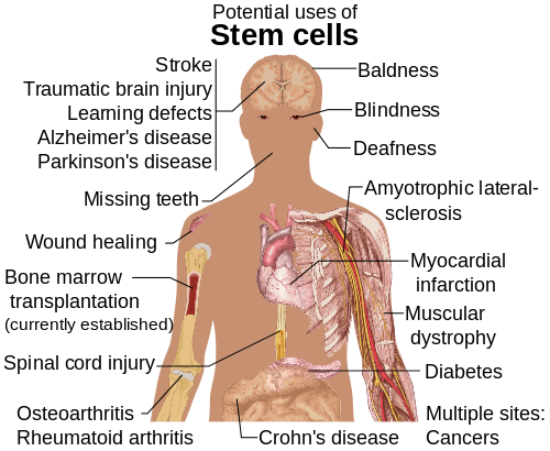 Différence entre la transplantation de cellules souches et la greffe de moelle osseuse