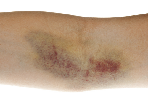 Diferencia entre el hematoma subgaleal y el cefalohematoma