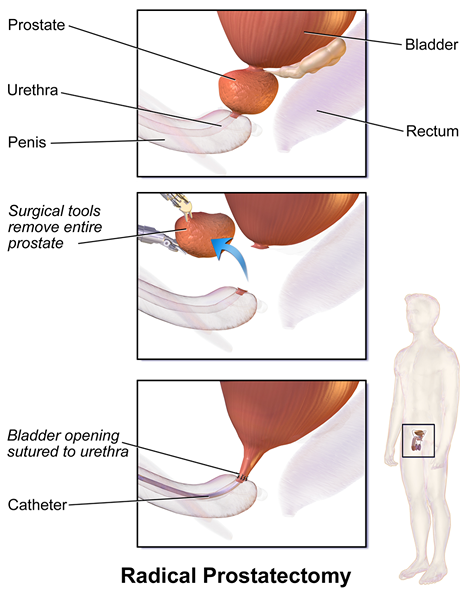 Différence entre la chirurgie et les radiations pour le cancer de la prostate