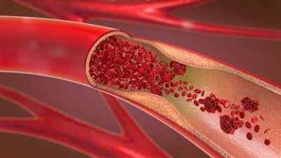 Différence entre le thrombus et l'embolie