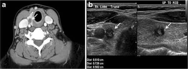Diferencia entre el nódulo tiroideo y el quiste