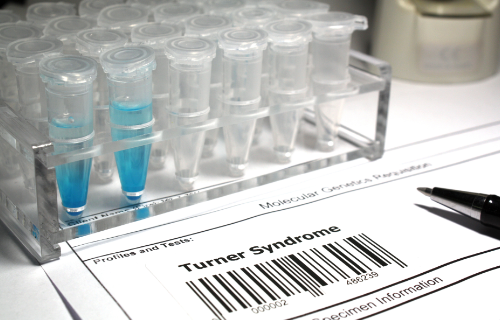 Unterschied zwischen dem Turner -Syndrom und dem Klinefelter -Syndrom