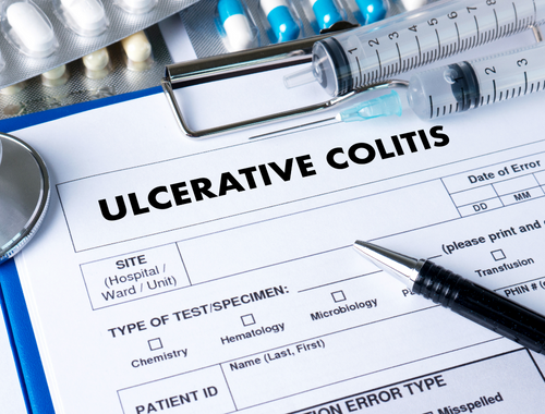 Unterschied zwischen Colitis ulcerosa und Divertikulitis