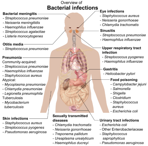 Unterschied zwischen Infektion der oberen Atemwege und Bronchitis