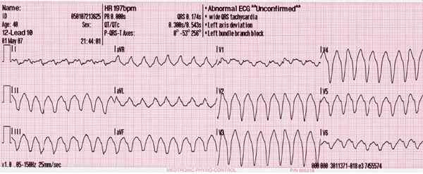 Différence entre la tachycardie ventriculaire (VTACH) et la fibrillation ventriculaire (VFIB)