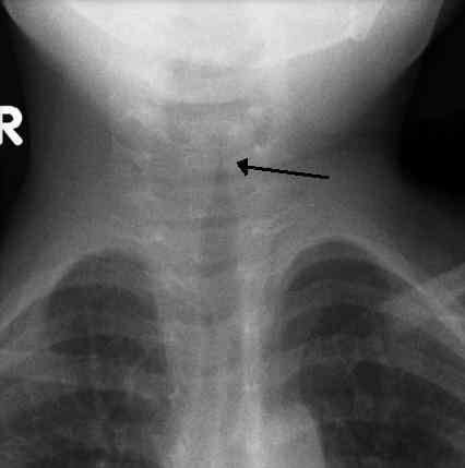 Différence entre la coqueluche et le croup