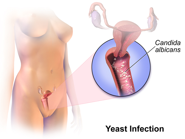 Diferencia entre la infección por levaduras y la vaginosis bacteriana BV