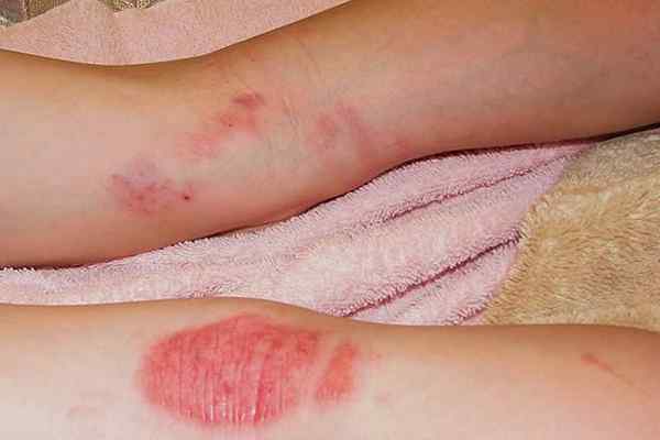Eczema vs. Psoriasis
