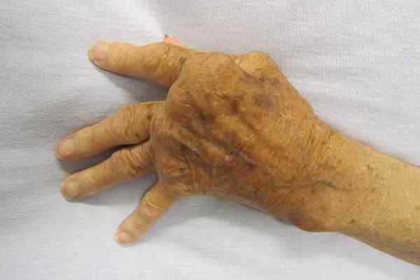 Gota vs. Artritis reumatoide