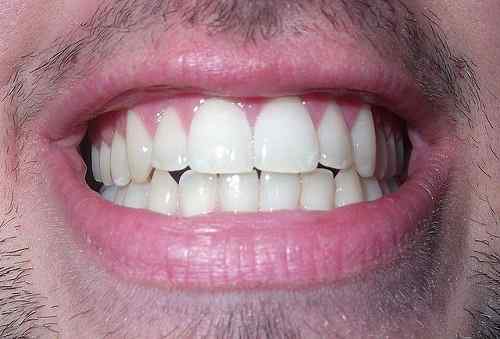 Der Unterschied zwischen Zahn und Zähnen