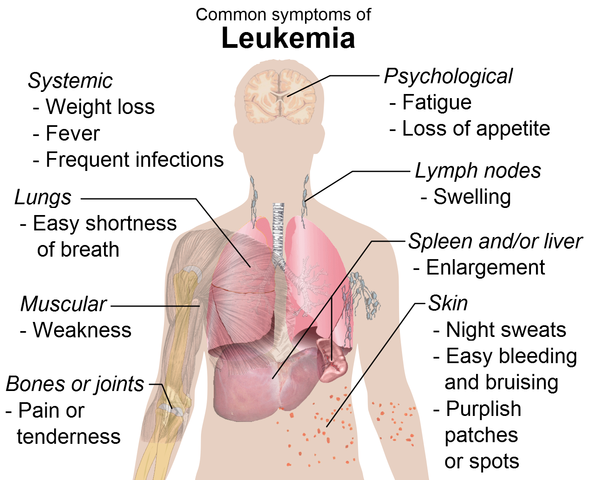 Diferencia entre leucemia aguda y crónica