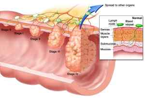 Différence entre le cancer anal et les hémorroïdes?