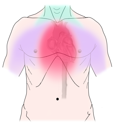 Diferencia entre la angina pectoris y el infarto de miocardio