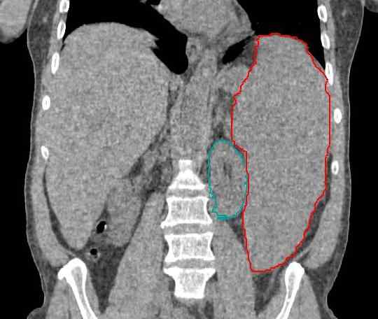 Diferencia entre la anemia aplásica y el síndrome de mielodisplásico