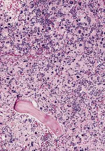 Diferencia entre la anemia aplásica y la pancitopenia