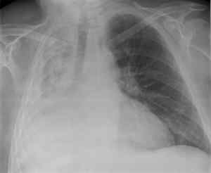 Perbezaan antara atelectasis dan bronchiectasis