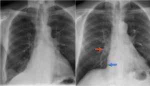 Différence entre l'atelectasie et la pneumonie