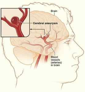 Unterschied zwischen AVM und Gehirnaneurysma