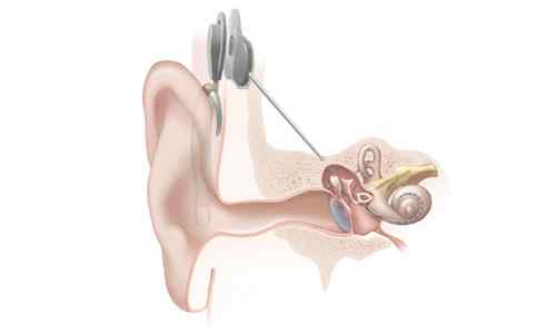 Unterschied zwischen Baha und Cochlea -Implantat