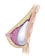 Diferencia entre el aumento de senos e implantes mamarios?