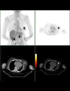 Unterschied zwischen Brustkrebs und Lymphom?