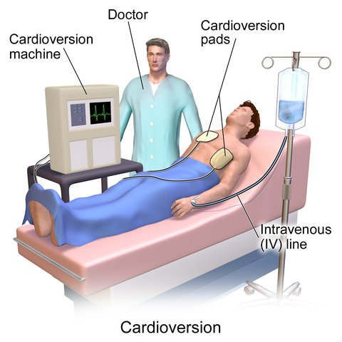 Unterschied zwischen Kardioversion und Defibrillation