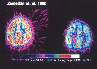 Unterschied zwischen Dextroamphetamin und Adderall