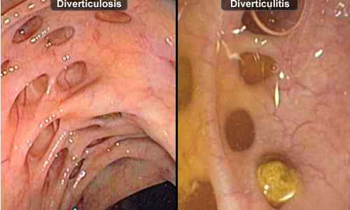 Perbezaan antara diverticulosis dan diverticulitis