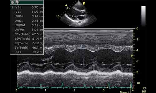 Différence entre l'ECG et l'échocardiographie