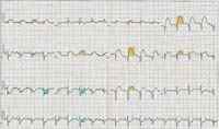 Diferencia entre ECG y EEG