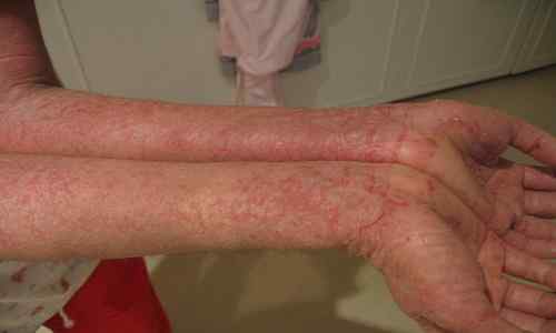 Diferencia entre eccema y dermatitis atópica