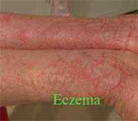 Perbezaan antara ekzema dan psoriasis