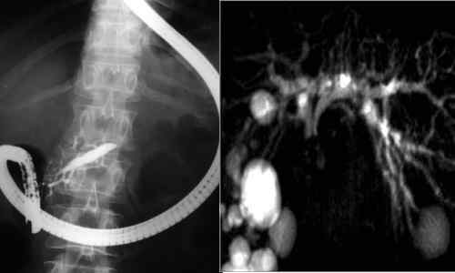 Perbezaan antara ERCP dan MRCP