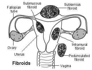 Perbezaan antara fibroid dan sista