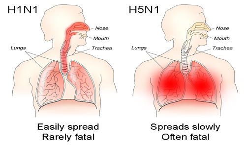 Différence entre la grippe et la grippe gastrique