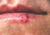 Diferencia entre verrugas genitales y herpes