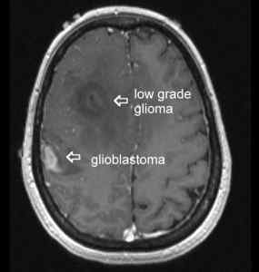 Perbezaan antara glioma dan glioblastoma