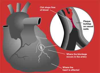 Diferencia entre el ataque cardíaco y el accidente cerebrovascular