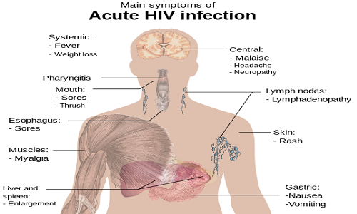 Diferencia entre el VIH/SIDA y la gripe