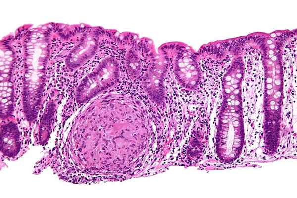 Diferencia entre la enfermedad de la EII y Crohn