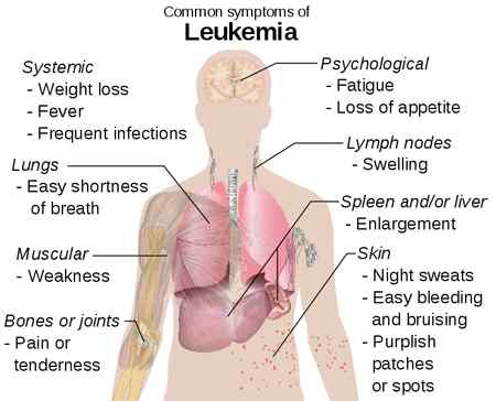 Unterschied zwischen Lymphom und Leukämie