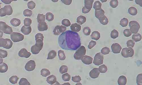 Perbezaan antara myeloblast dan limfoblast