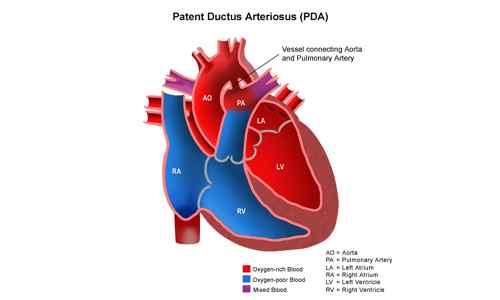 Perbedaan antara PFO dan PDA