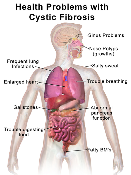 Perbedaan antara pneumonia dan fibrosis kistik