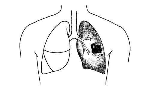 Différence entre la pneumonie et l'abcès pulmonaire.
